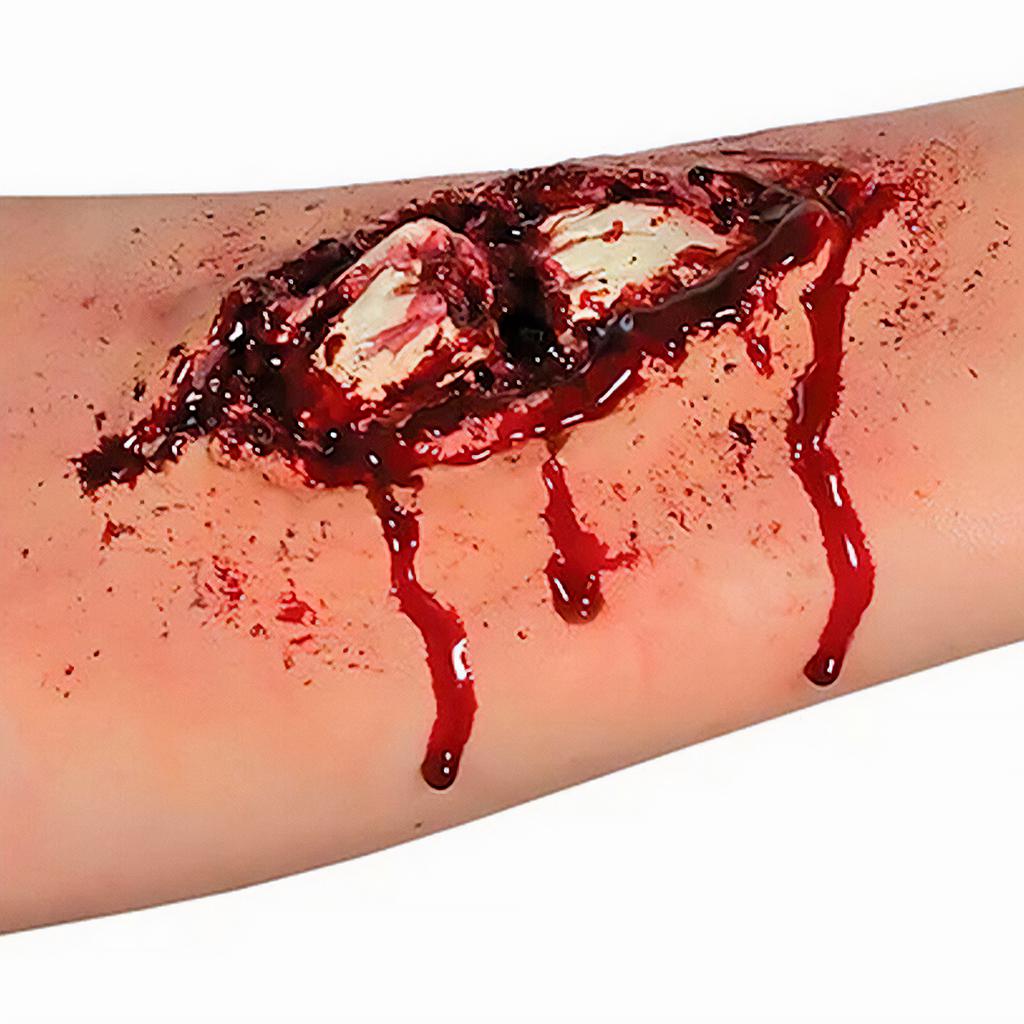 WO163 Prostético de Hueso Roto