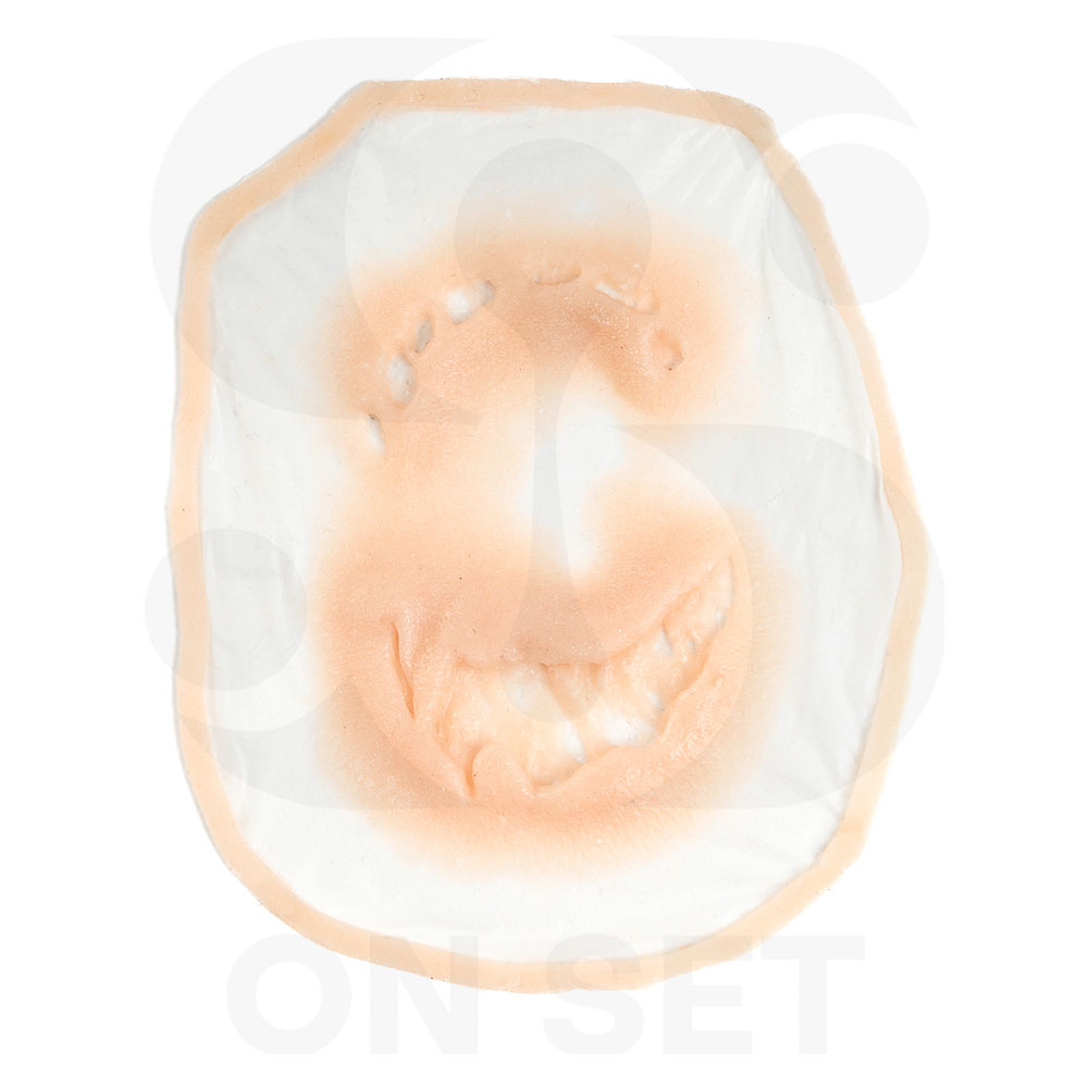 (ONSET) Prostético de Mordida Grande