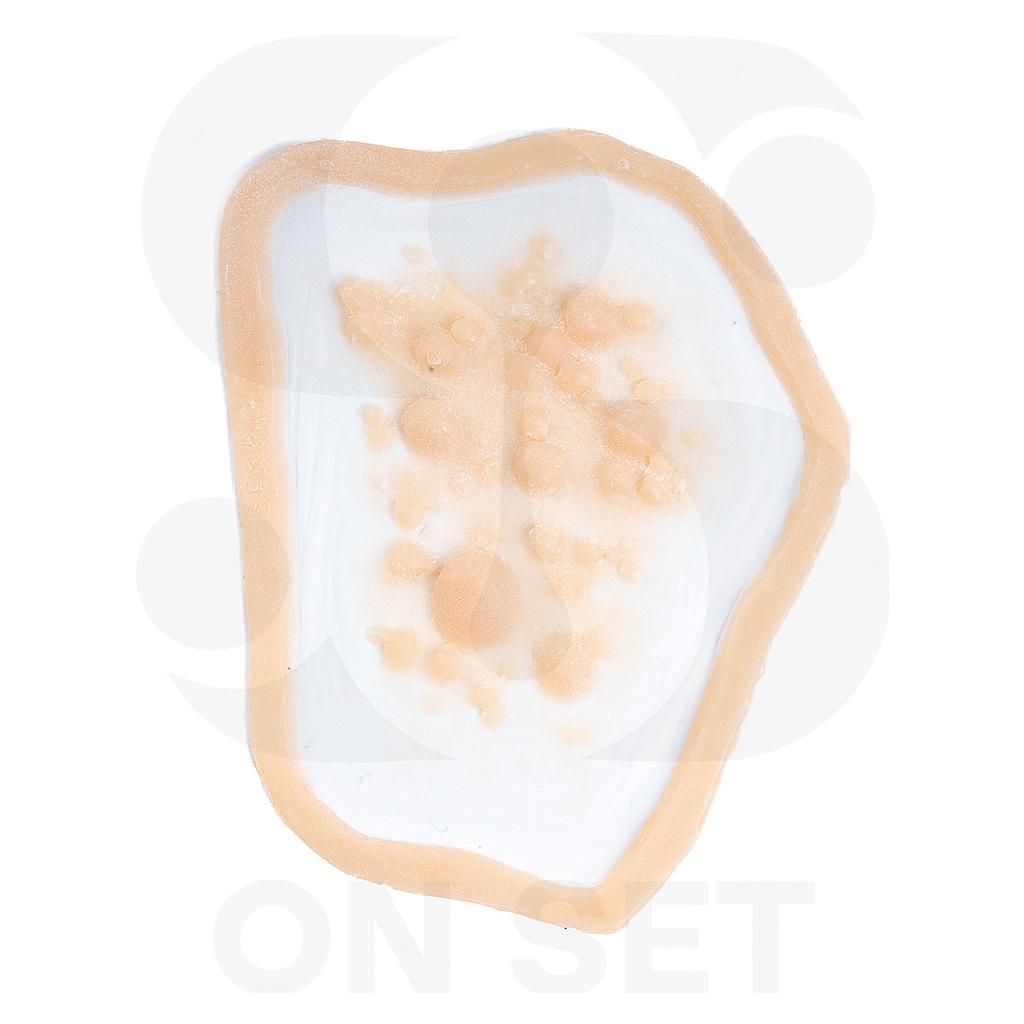 (ONSET) Prostético de Infección