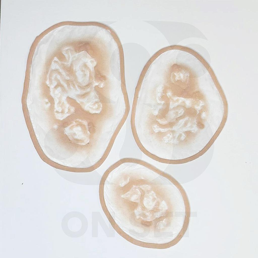 (ONSET) Prostético Quemadura