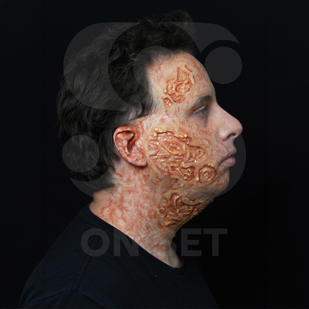 (ONSET) Prostético Quemadura