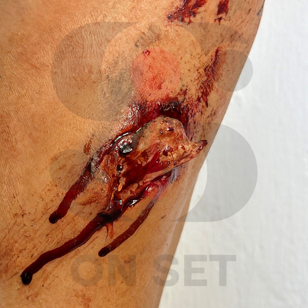 (ONSET) Prostético de Fractura Expuesta