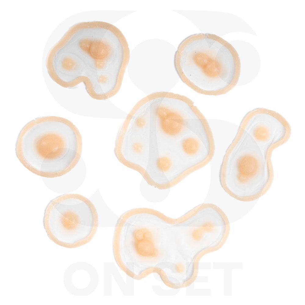 (ONSET) Prostético de Infección/ámpulas