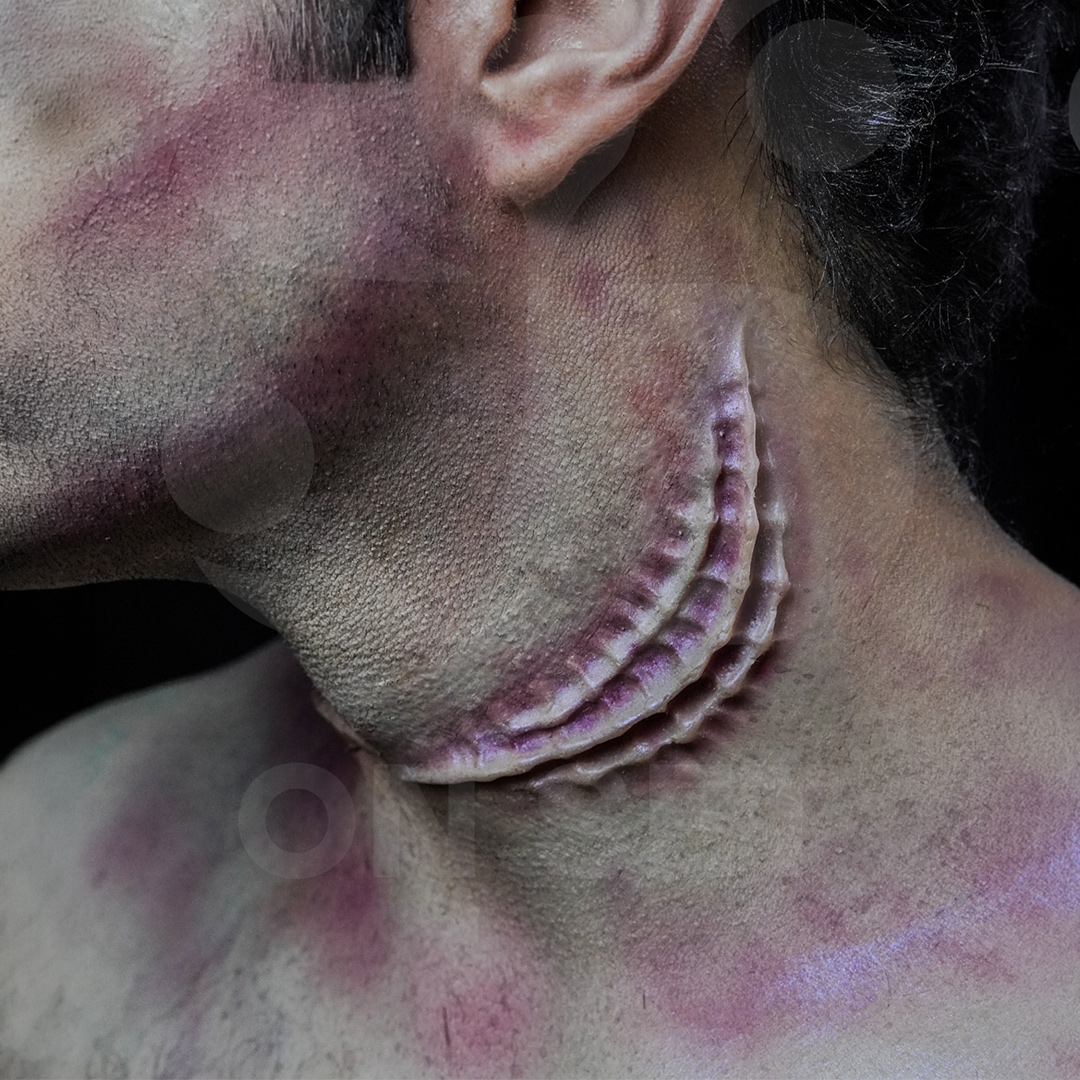 (ONSET) Prostético Branquias Brazos